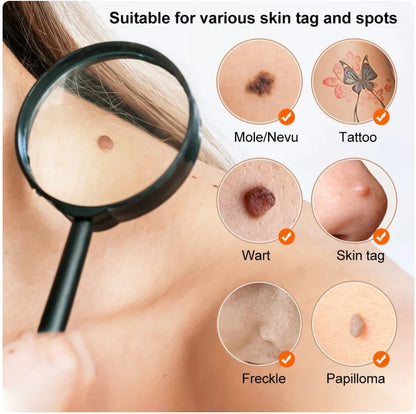 Natravor® Non-Invasive Mole and Wart Removal Laser Pen